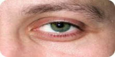 علاج التهاب جفن العين العلوي