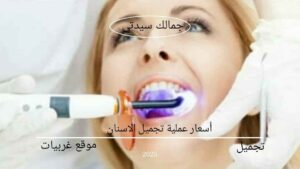 أسعار عملية تجميل الاسنان